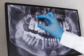 Radiografia Odontológica mais detalhada com uma mão medindo o tamanho de um dente com os dedos. 