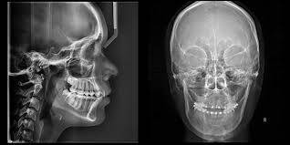 Imagem de um crânio humano através de uma Radiografia Extraoral